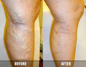 Stop Pain & Look Better With A Visit To A Vein Doctor In Schaumburg IL