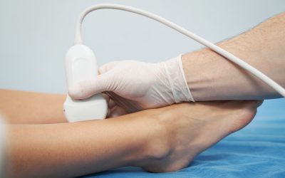 There Are Safe Solutions To Spider Vein Treatment